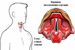 Лечение ларингита. Лор врач Андреев С.В. Днепропетровск